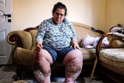 Fil hastası kadın, iyileşip çocuklarıyla ilgilenmek istiyor Fil hastası kadın, iyileşip çocuklarıyla ilgilenmek istiyor